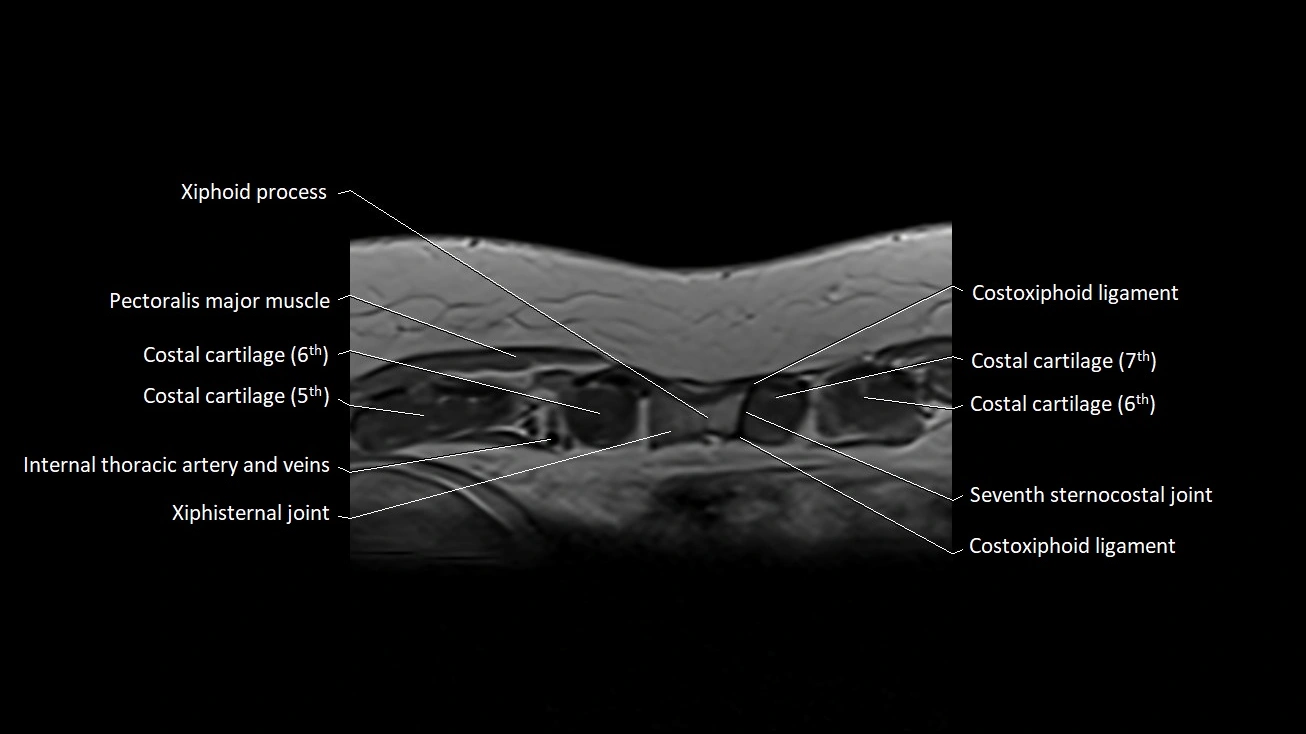 MRI sternum and sternoclavicular joint labeled axial anatomy image 34.webp